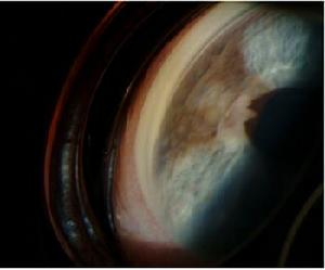 原發性急性閉角型青光眼