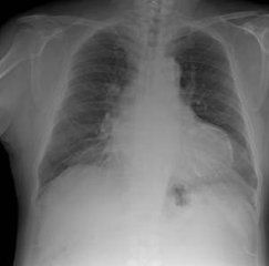 老年人厭氧菌性肺炎 老年人厭氧菌性肺炎