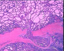 甲狀腺濾泡癌 甲狀腺濾泡癌