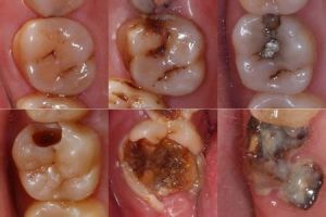 乳牙齲病 乳牙齲病