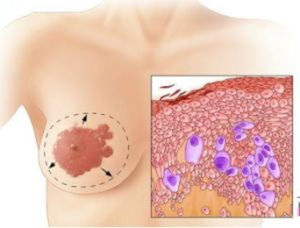 佩吉特病 佩吉特病