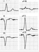 預激綜合徵 預激綜合徵
