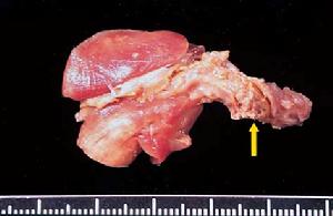 急性滲出性胸膜炎