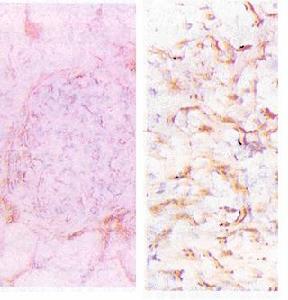 慢性間質性腎炎