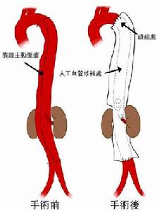 梅毒性主動脈瘤