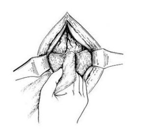 尿道缺如及先天性尿道閉鎖 尿道缺如及先天性尿道閉鎖