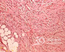 嗜酸細胞性筋膜炎