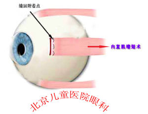 斜視手術示意圖