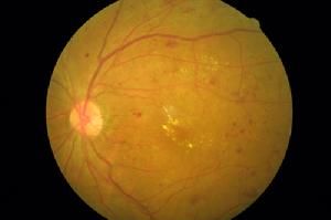 急性淋巴細胞性白血病視網膜病變