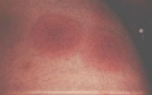 小兒紫斑濕疹綜合徵