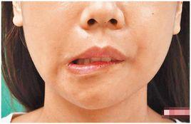 口角歪斜 口角歪斜