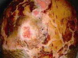 頭皮壞死 頭皮壞死