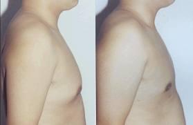 男子乳房發育症