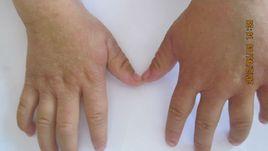 摩擦性苔癬樣疹 摩擦性苔癬樣疹