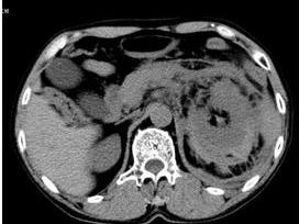 腹部閉合性損傷