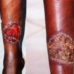 熱帶潰瘍 熱帶潰瘍