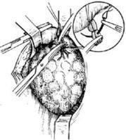 甲狀腺次全切除術