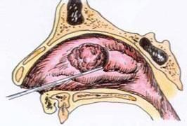 耳鼻咽喉創傷 耳鼻咽喉創傷