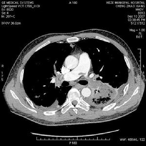 脂肪栓塞綜合徵