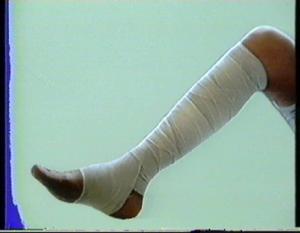 下肢靜脈瓣膜關閉不全