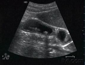 膽囊腺肌症 膽囊腺肌症