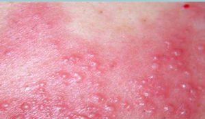 自體敏感性濕疹針狀