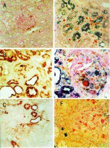 新月體腎炎 新月體腎炎