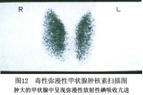 毒性瀰漫性甲狀腺腫