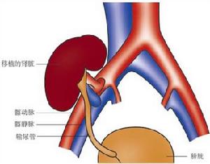 新生兒腎靜脈血栓