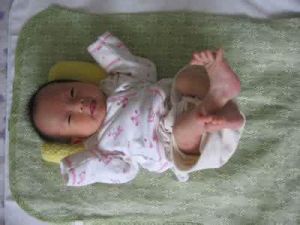 嬰兒剪刀腳 嬰兒剪刀腳