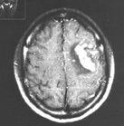 化膿性腦膜腦炎 化膿性腦膜腦炎