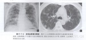 小兒特發性肺含鐵血黃素沉著症 小兒特發性肺含鐵血黃素沉著症