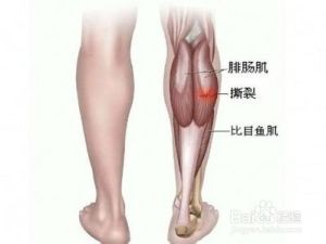 肌腱拉傷 肌腱拉傷