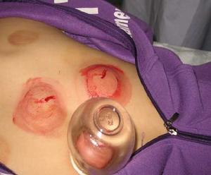 閃罐療法 閃罐療法