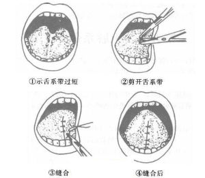 舌系帶手術