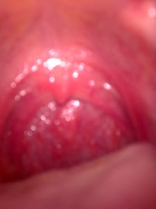 慢性鼻咽炎 慢性鼻咽炎