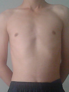 小兒雞胸 小兒雞胸