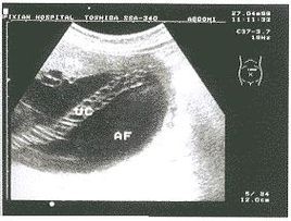 臍帶帆狀附著 臍帶帆狀附著