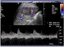 肝局灶性結節性增生