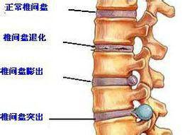 腰椎間盤退變 腰椎間盤退變