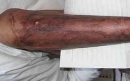 燒傷創面焦痂提前潮解脫落或出現蟲咬樣變化 燒傷創面焦痂提前潮解脫落或出現蟲咬樣變化