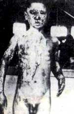 光輻射使孩子面部上半身和上肢燒傷，上半身皮膚大面積剝落