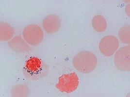 鐵粒幼細胞 鐵粒幼細胞