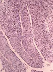 （圖）膀胱移行細胞癌