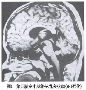 脈絡叢乳頭狀瘤