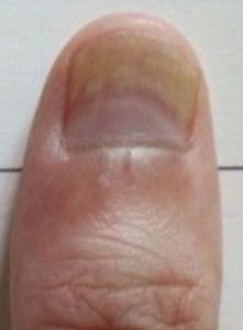 真菌感染型灰指甲