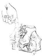 肥厚性心肌病 肥厚性心肌病