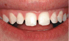 超薄牙貼面 超薄牙貼面