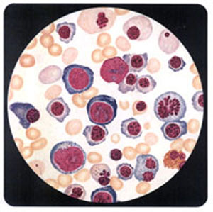 陣發性冷性血紅蛋白尿