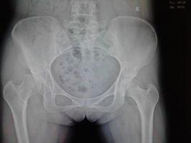 髖關節發育不良 髖關節發育不良